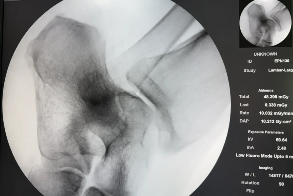 Fluoroscopic image of the ankle and heel taken during an image-guided ankle joint injection.