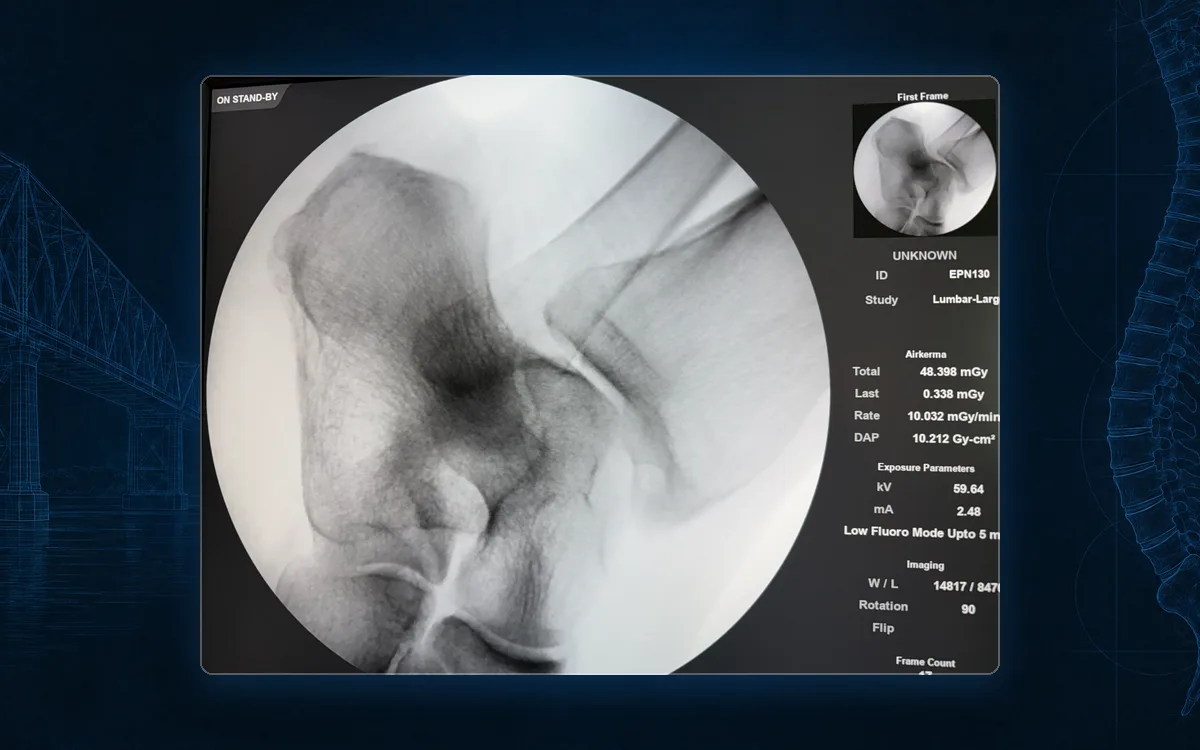 Fluoroscopy of the ankle and heel during an image-guided ankle joint injection.